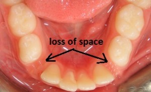 Early loss of baby teeth
